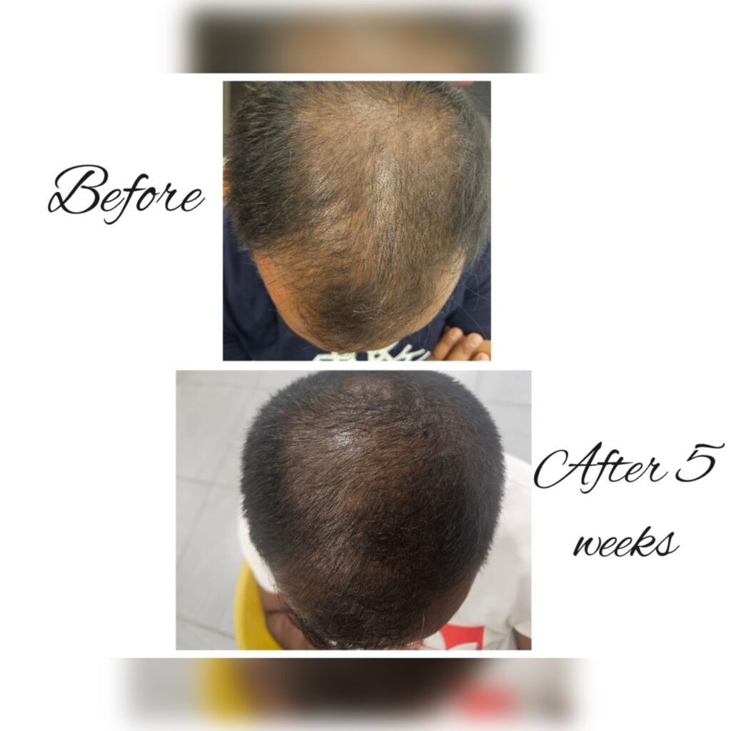 Scalp before and after five weeks of hair loss treatment