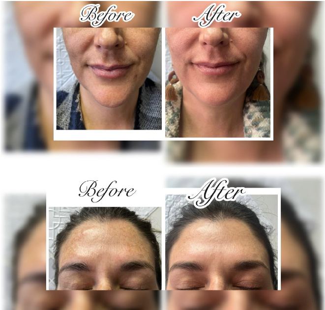 Before and after: forehead and lower face