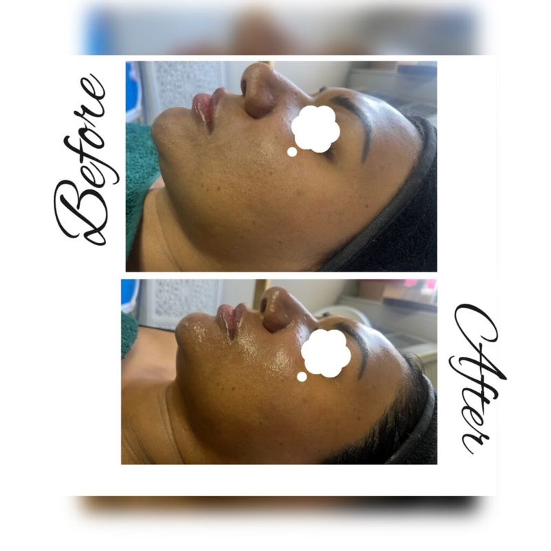 Before and after: cheek