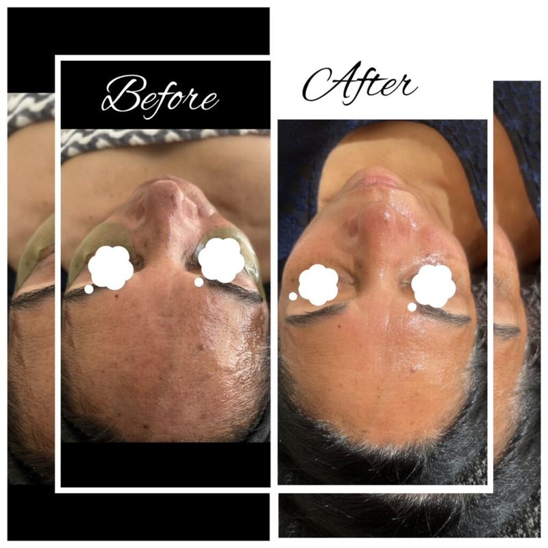 Before and after: full face